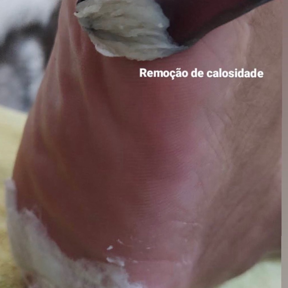 Plástica dos Pés