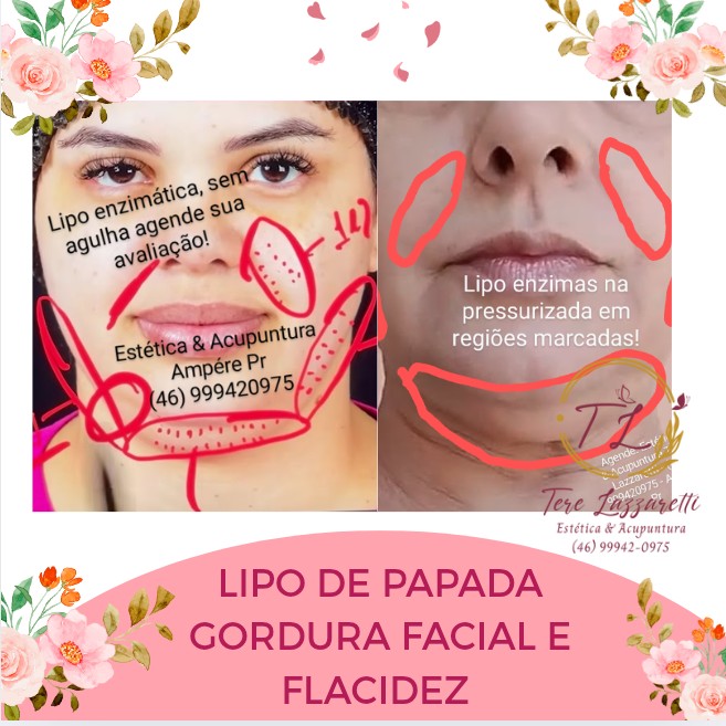 LIPO DE PAPADA + REDUÇÃO DE FLACIDEZ