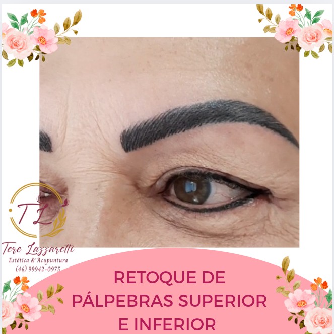 RETOQUE DE PÁLPEBRAS SUPERIOR E INFERIOR