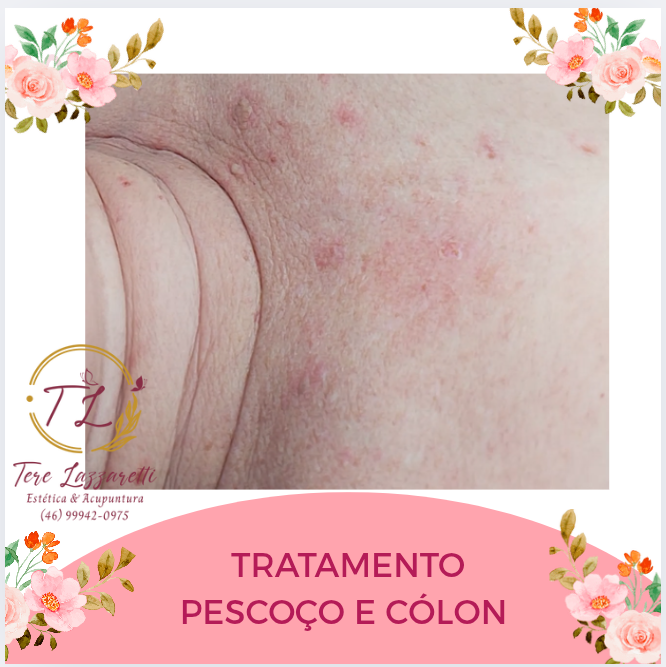 PESCOÇO E CÓLON REJUVENESCIMENTO