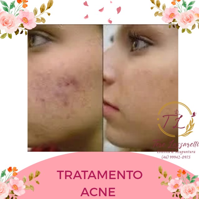 TRATAMENTO PARA ACNE JUVENIL