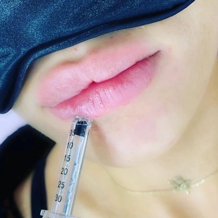 Preenchimento labial