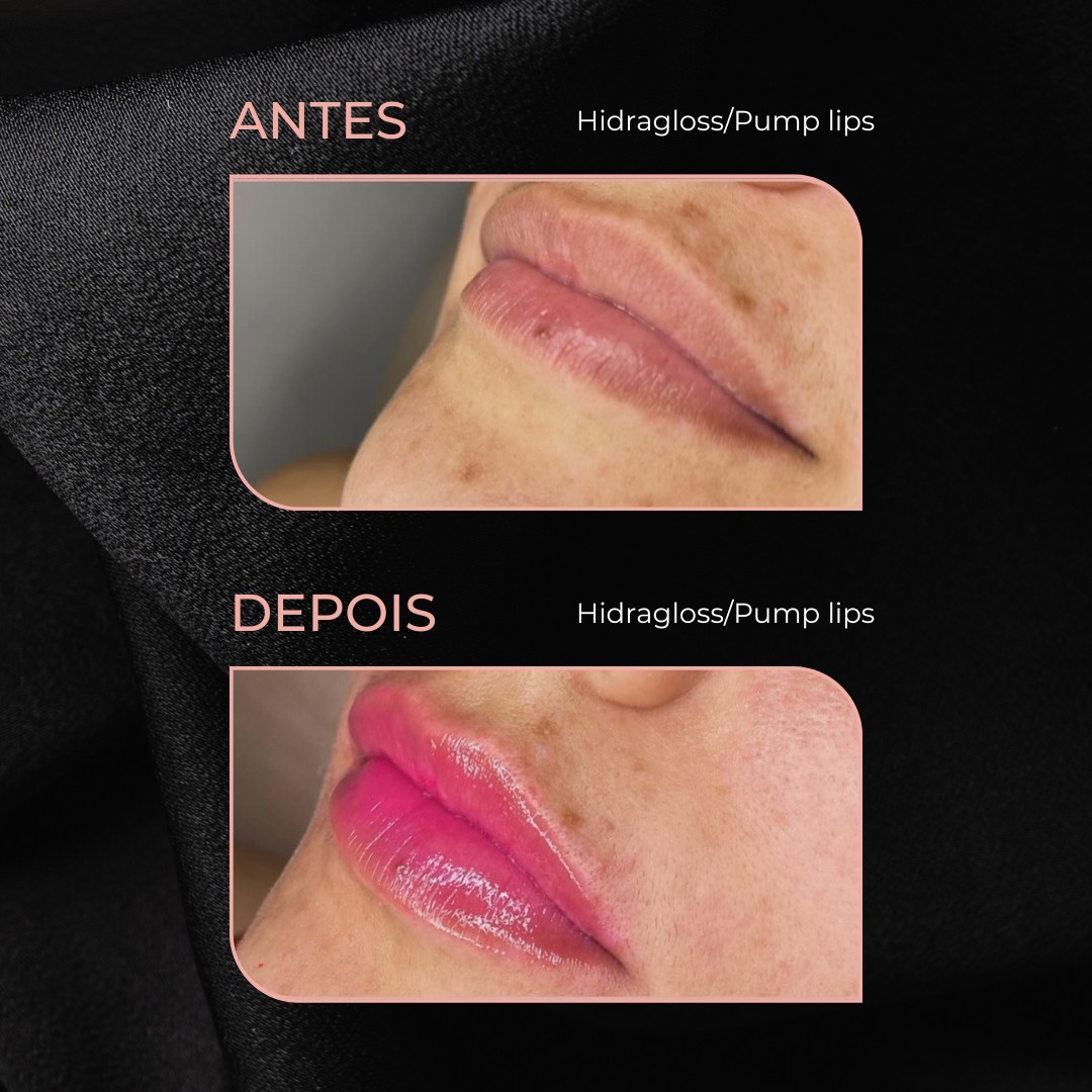 hidragloss