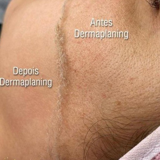 DERMAPLANING+ Argiloterapia