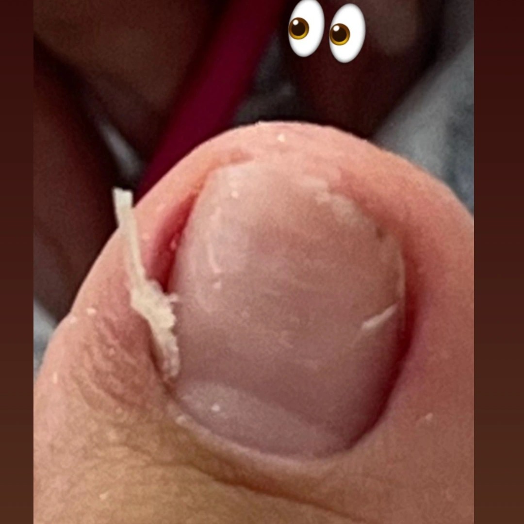pedicure + Onicofose = pele por baixo da unha
