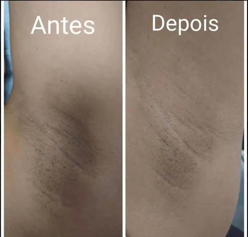 Clareamento íntimo 5 sessões