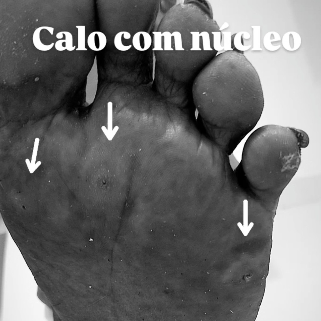 CALO/CALOSIDADE/RACHADURAS