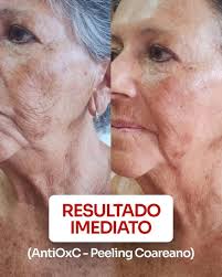 Peeling Coreano