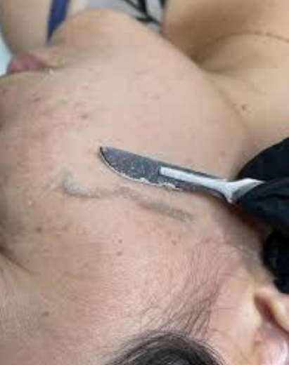Limpeza de pele + dermaplaning (promo)