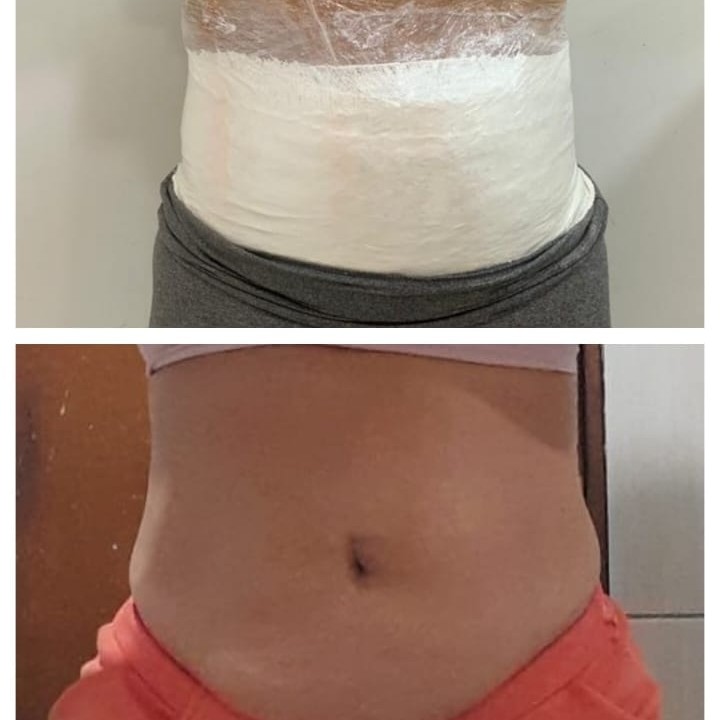 Gessoterapia com Modeladora