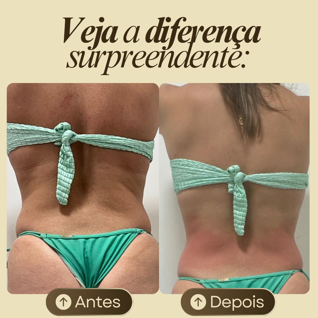 Retirada de gordura costas