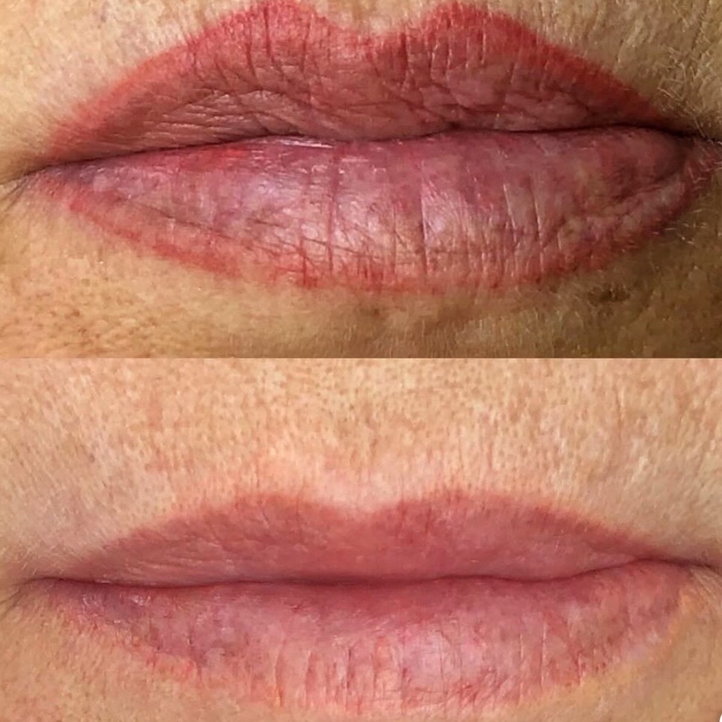 remoção de micro labial