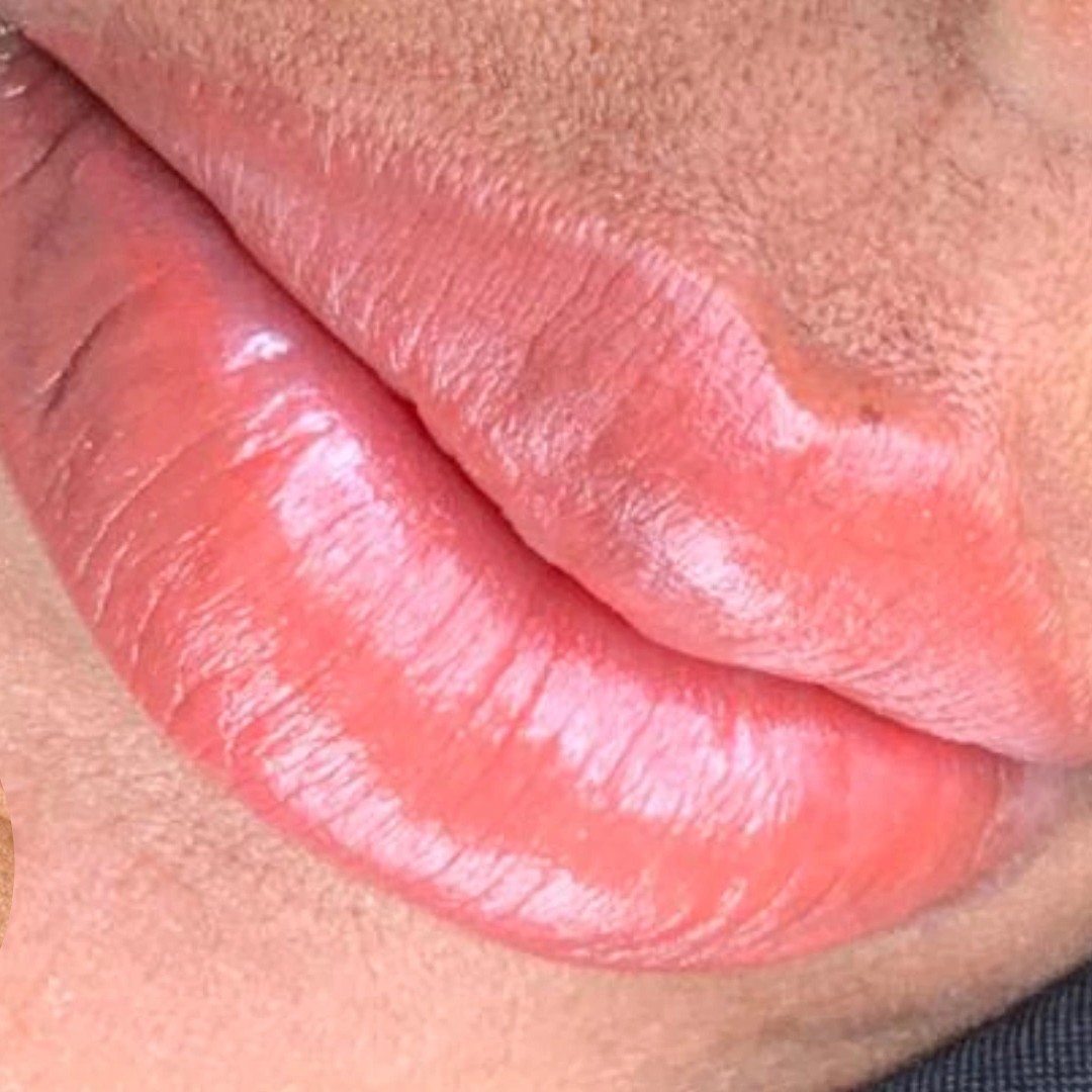 NEUTRALIZAÇÃO (MICRO LABIAL)