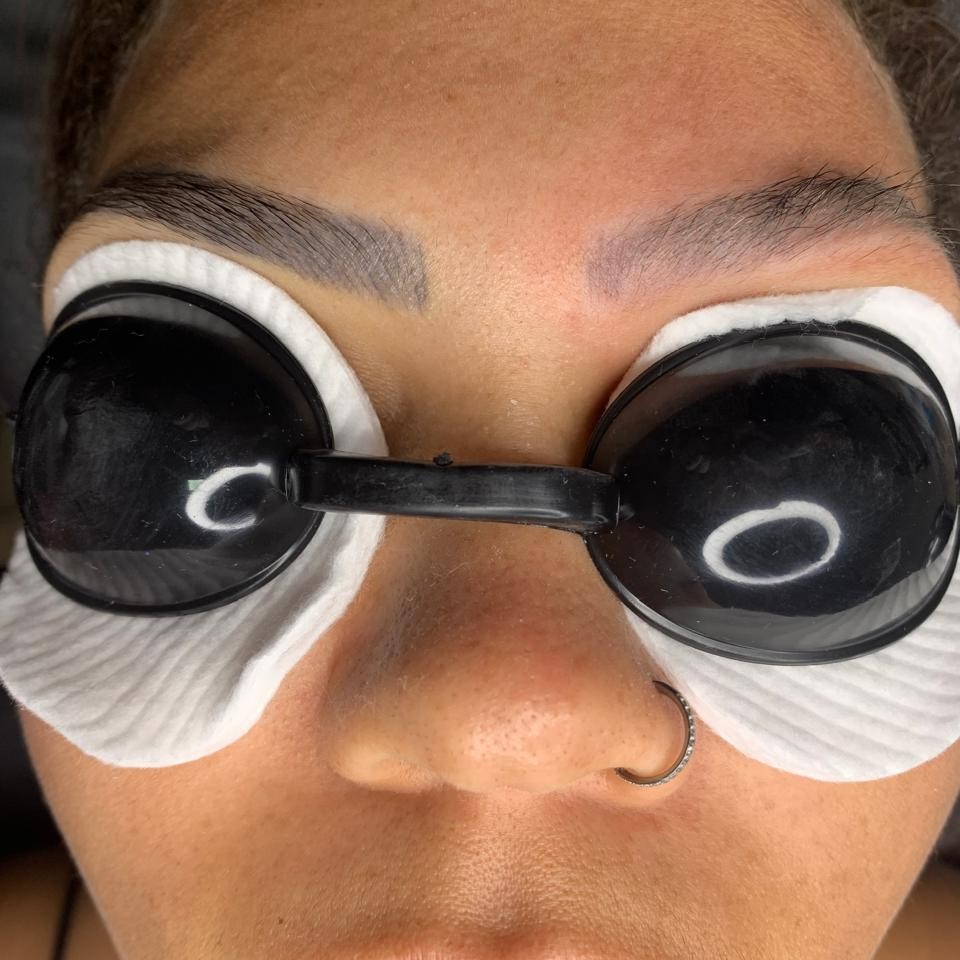 REMOÇÃO A LASER (SOBRANCELHA)