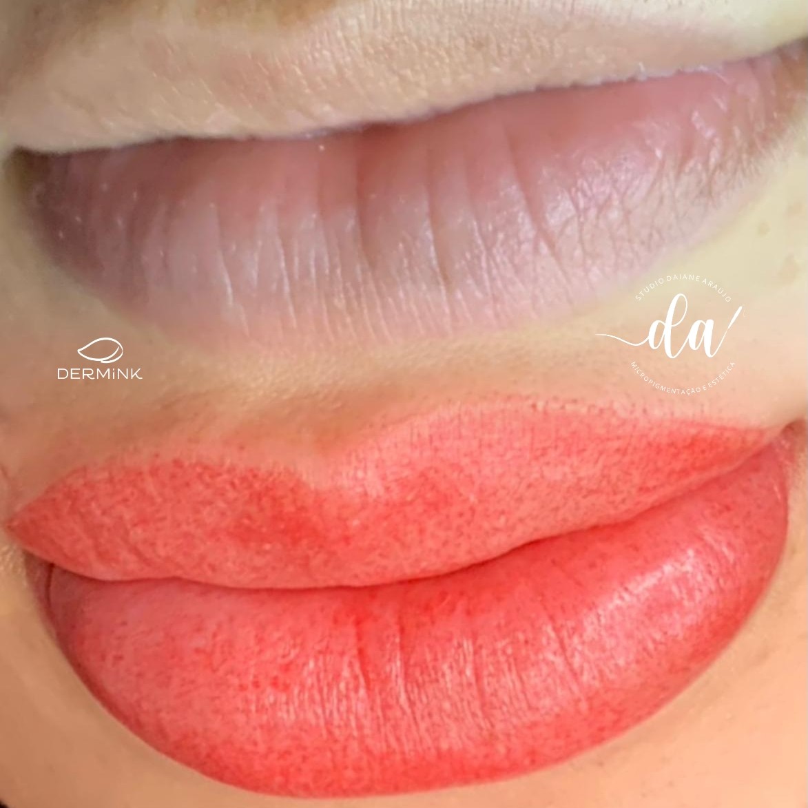 REVITALIZAÇÃO LABIAL