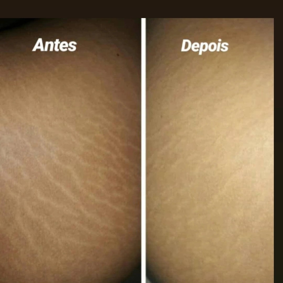 Dermopuntura em estrias