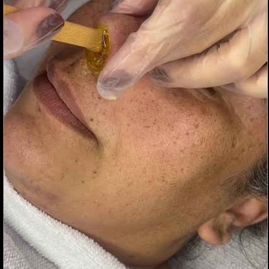 depilação da narina