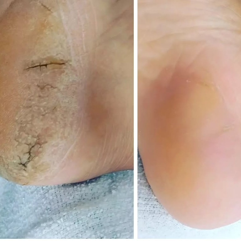 SPA dos Pés com Remoção de Onicocriptose