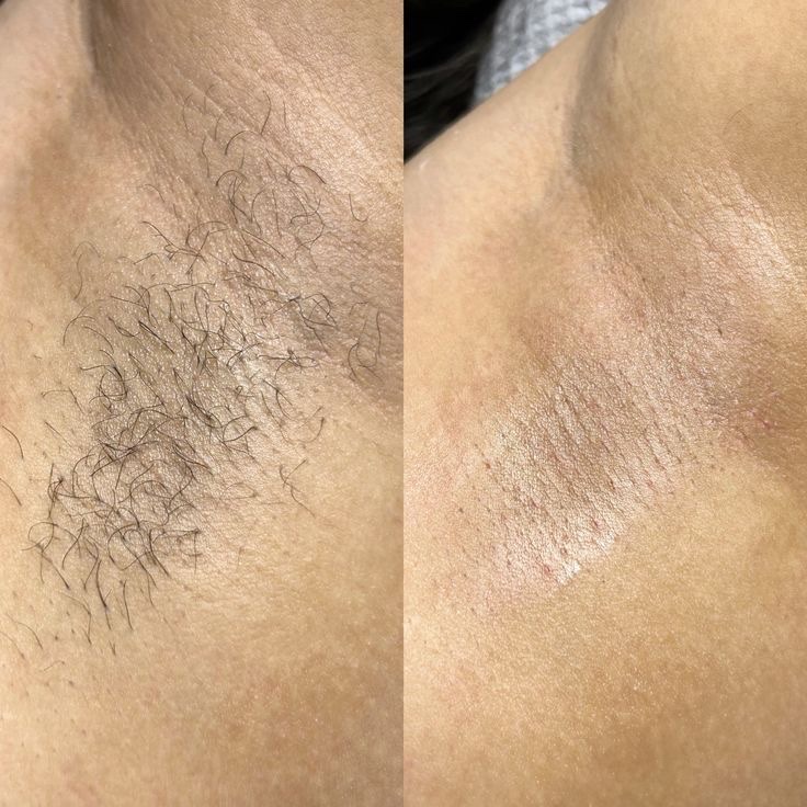 depilação de axila