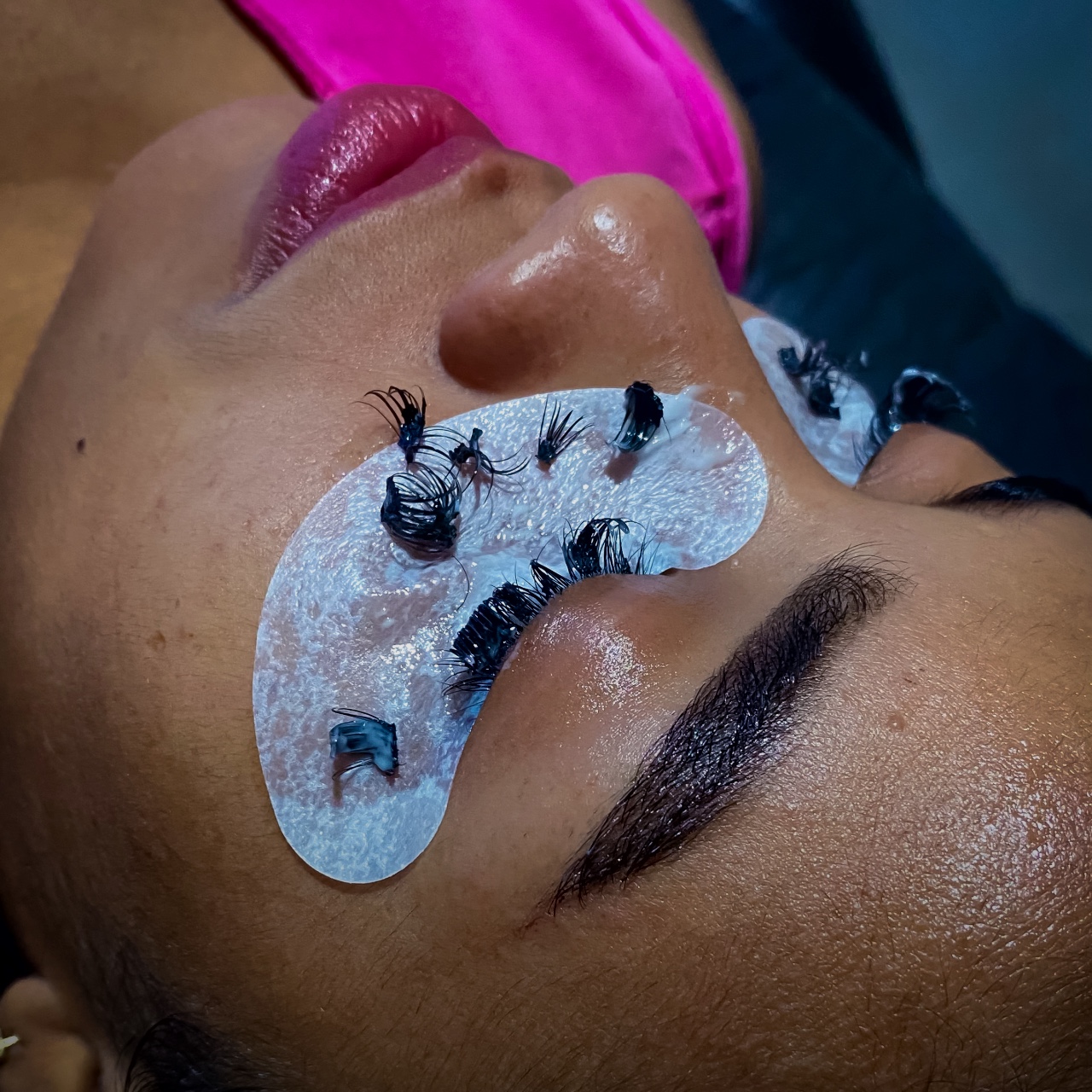 REMOÇÃO DE CÍLIOS