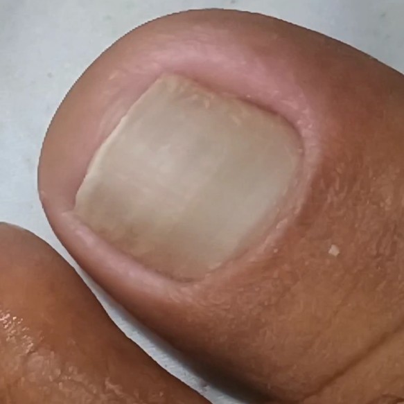 Corte Técnico das unhas