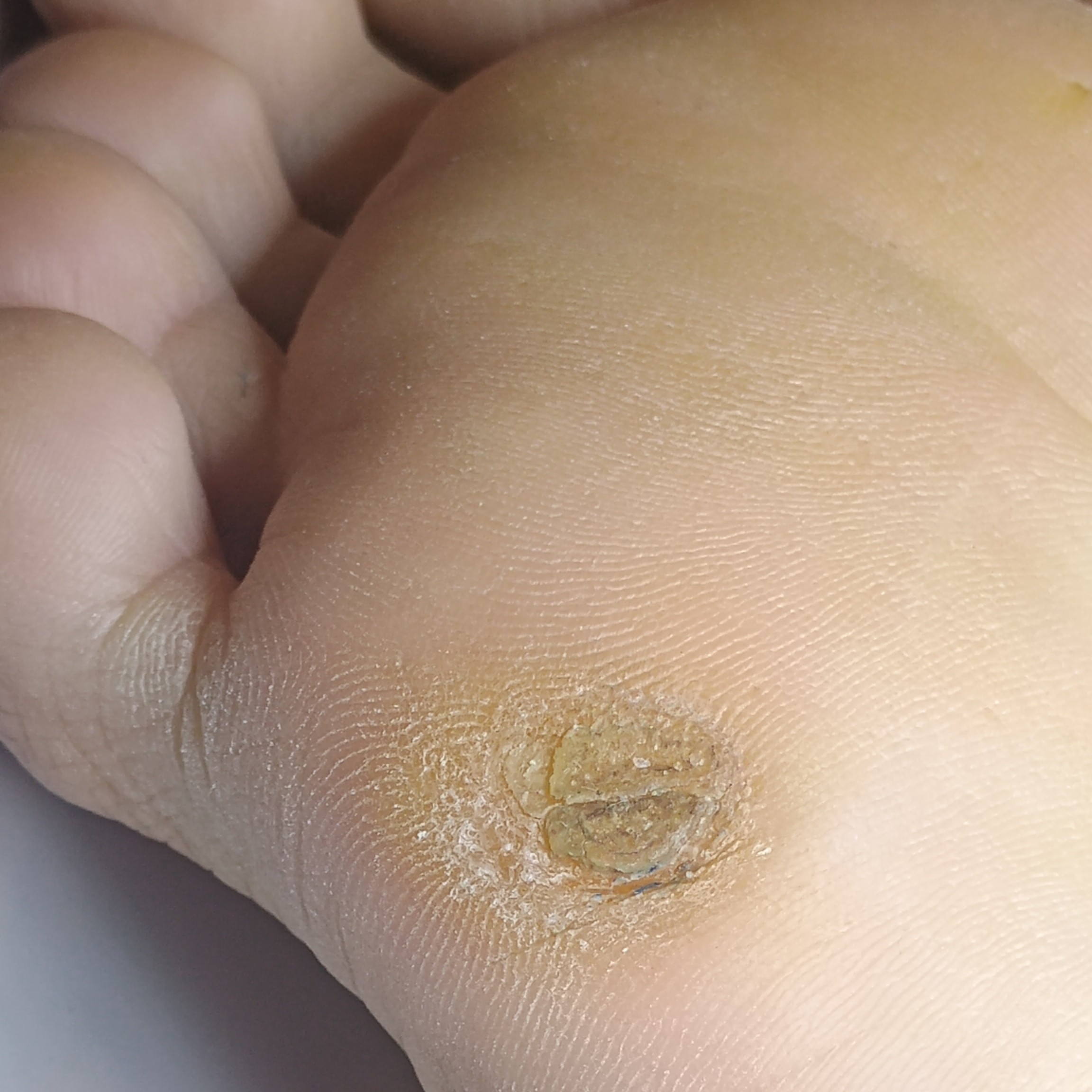 Tratamento de Calos e Calosidades