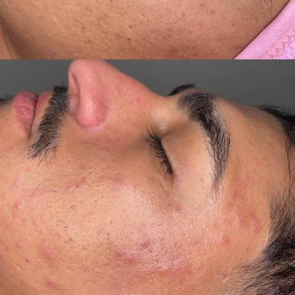 Combo Limpeza de Pele + Skincare Personalizado