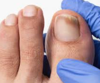 Plano Mensal Tratamento de Fungos Podologia