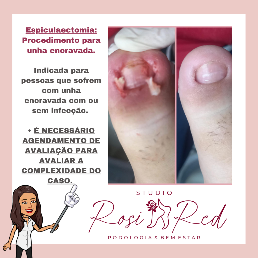 Avaliação para Unha encravada