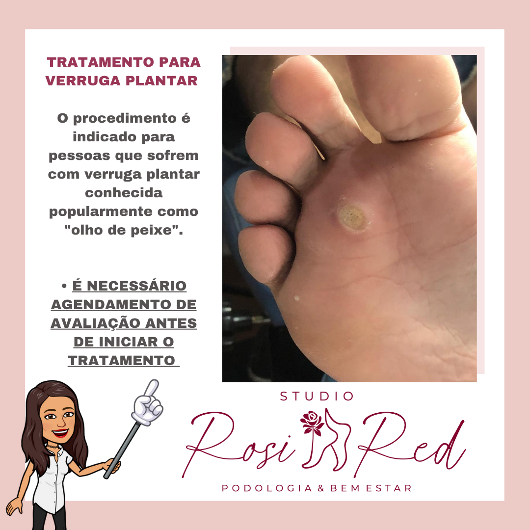 Avaliação de verruga plantar (olho de peixe)