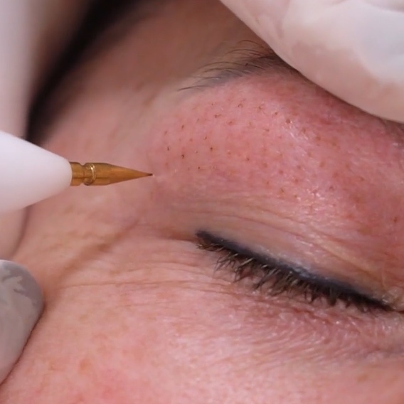 JATO DE PLASMA - remoção de sinais/rugas/levantamento de pálpebras - remoção de sinais/rugas/levantamento de pálpebras