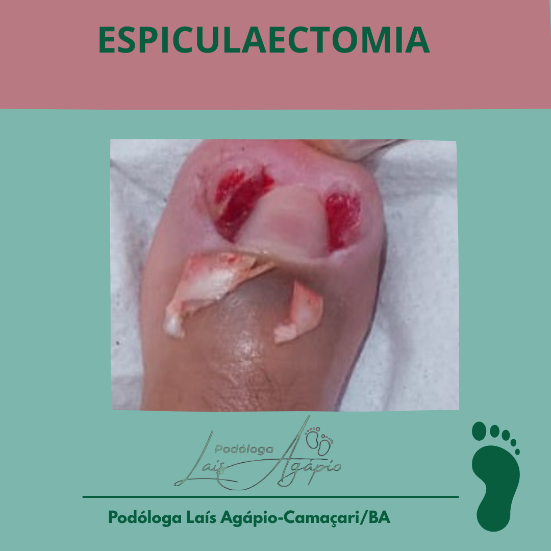ESPICULAECTOMIA/ UNHA ENCRAVADA - Serviço realizado em Camaçari, Bahia.