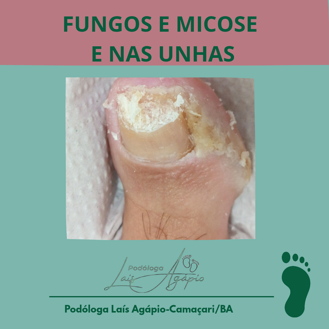 FUNGOS/MICOSE NAS UNHAS - Serviço realizado em Camaçari, Bahia.