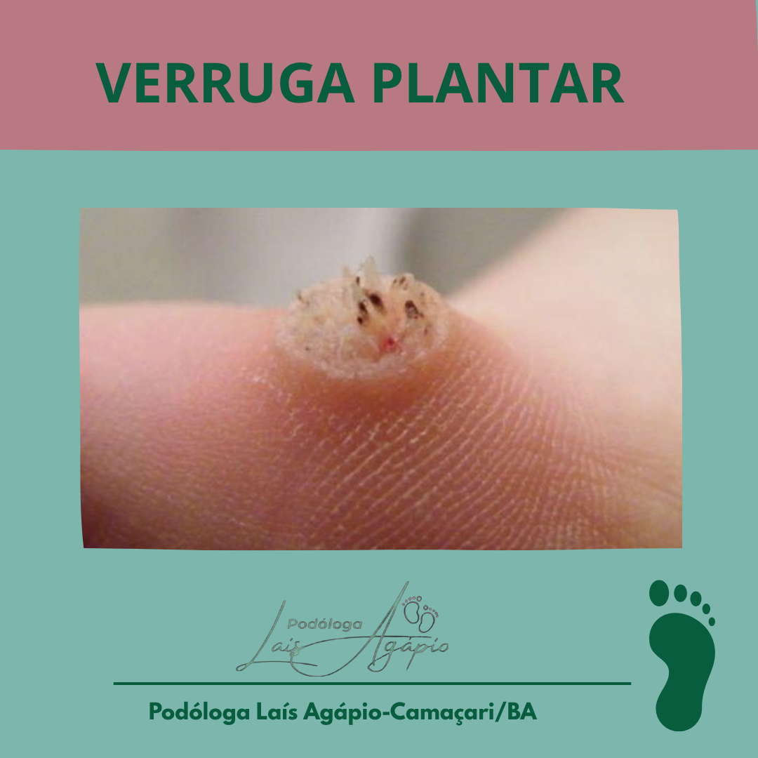 VERRUGA PLANTAR - Serviço realizado em Camaçari, Bahia.