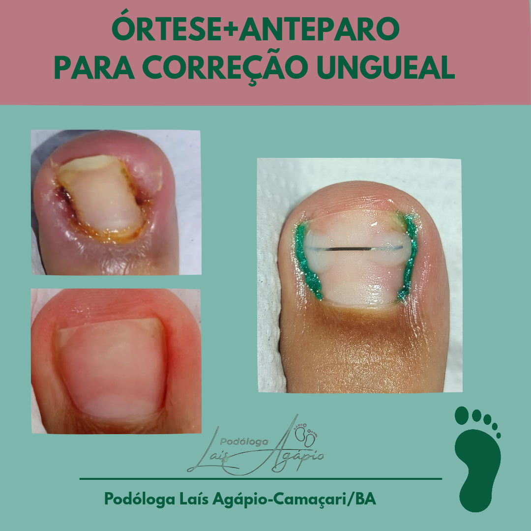 ÓRTESE UNGUEAL - Serviço realizado em Camaçari, Bahia.