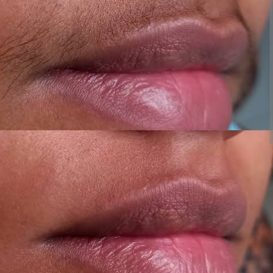 Depilação de burço