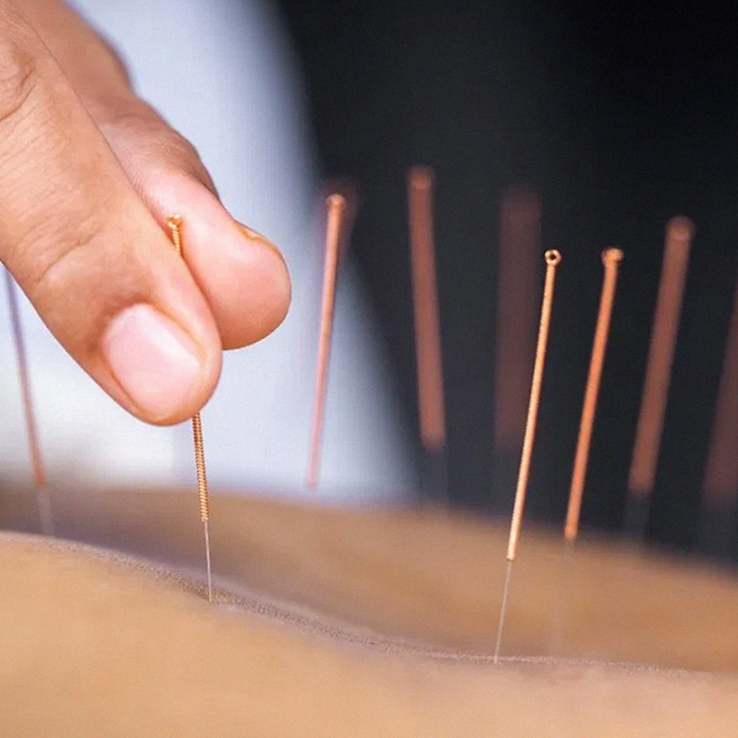 acupuntura