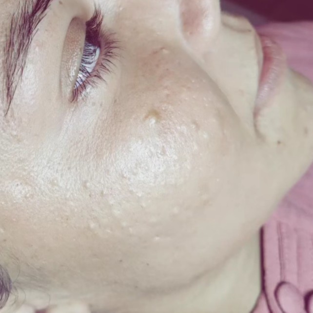 radiofrequência facial/extração de milium