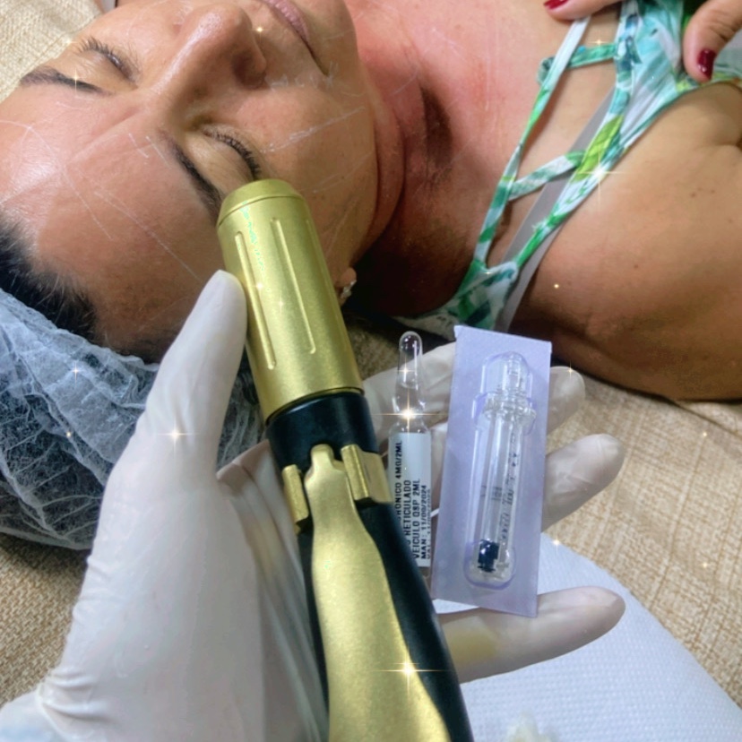 Hyaluropen Biorevitalização Facial com Ácido Hialurônico