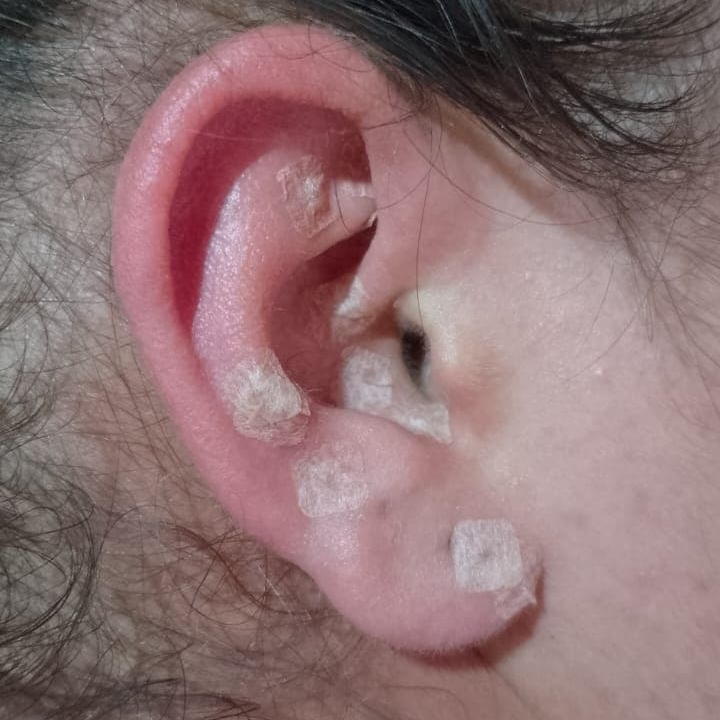 Auriculoterapia 4 sessões