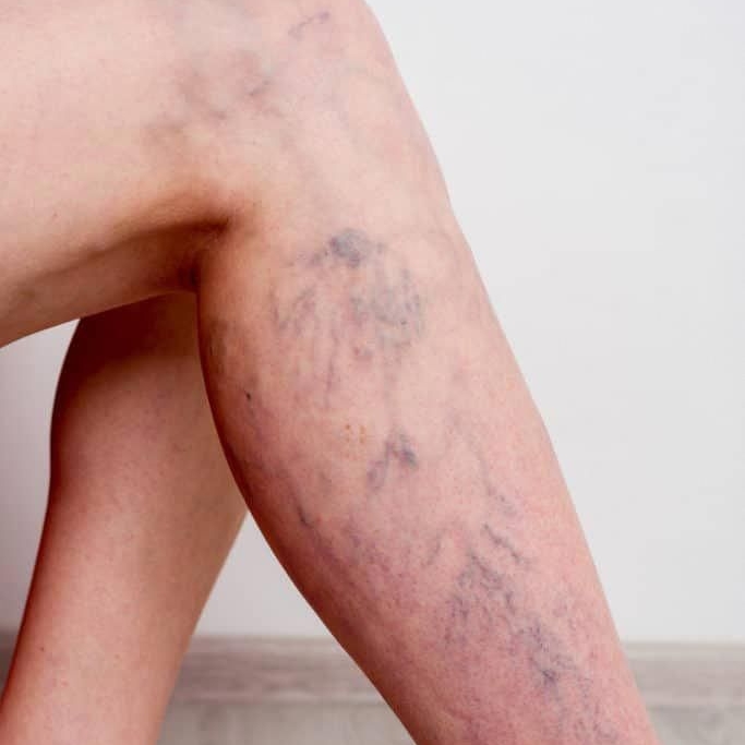 PEIM (microvasos) + Drenagem linfática local 2 sessões