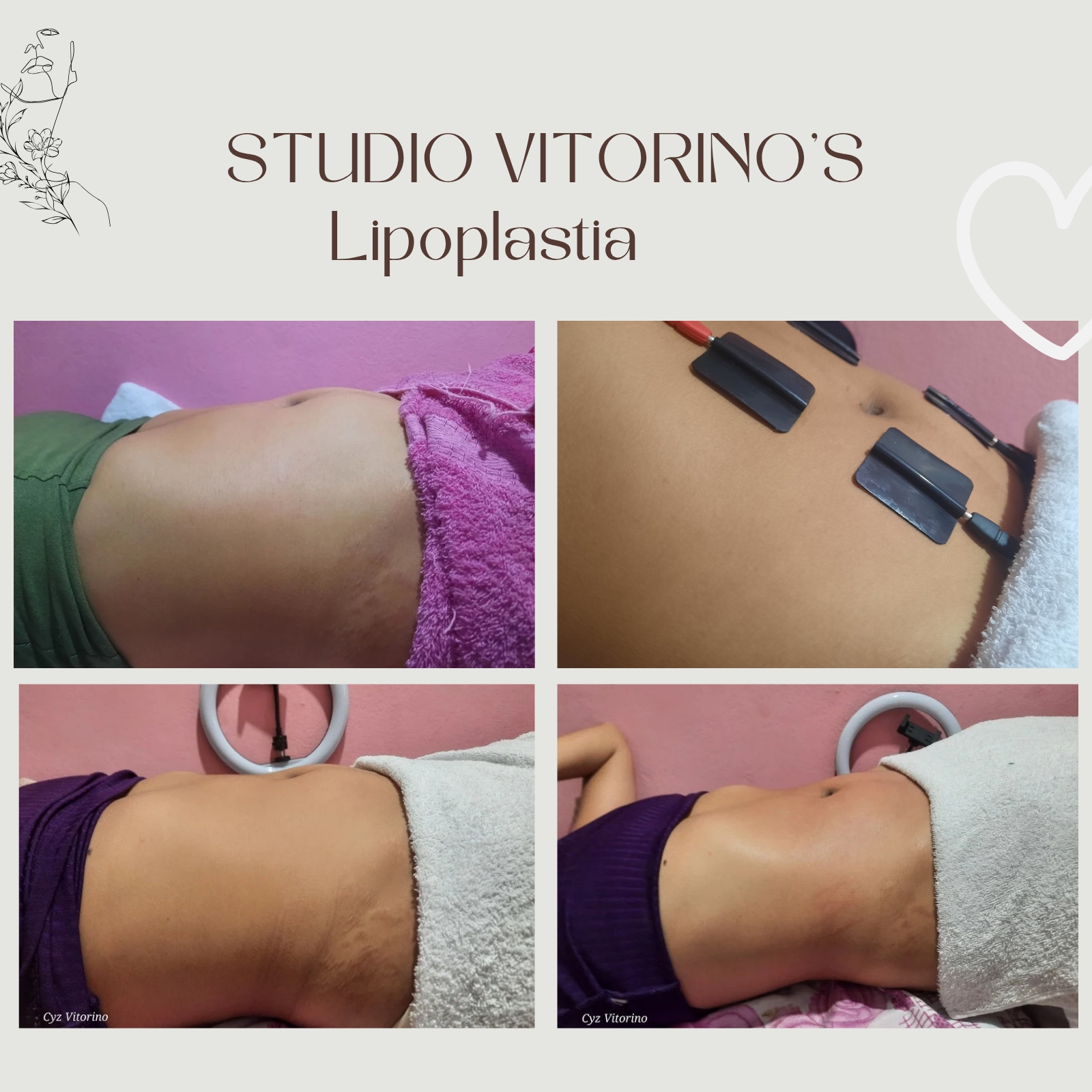 Lipoplastia