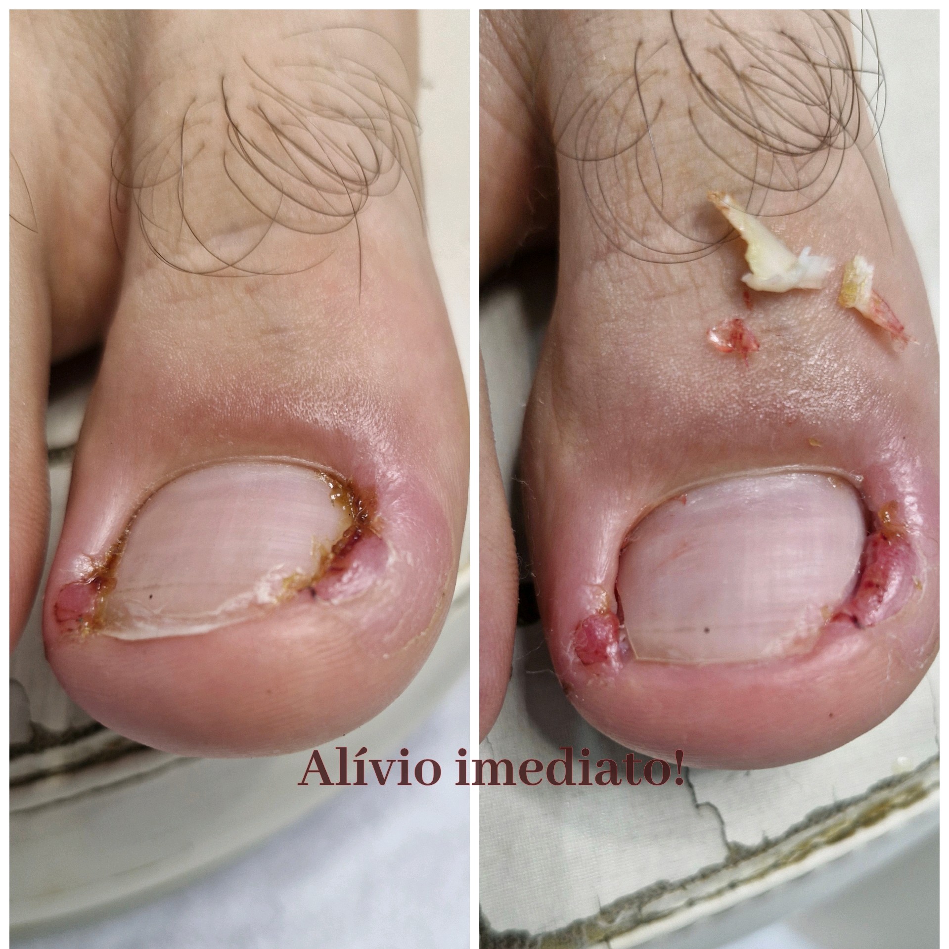 desencrave de unha infeccionada (cada unha)