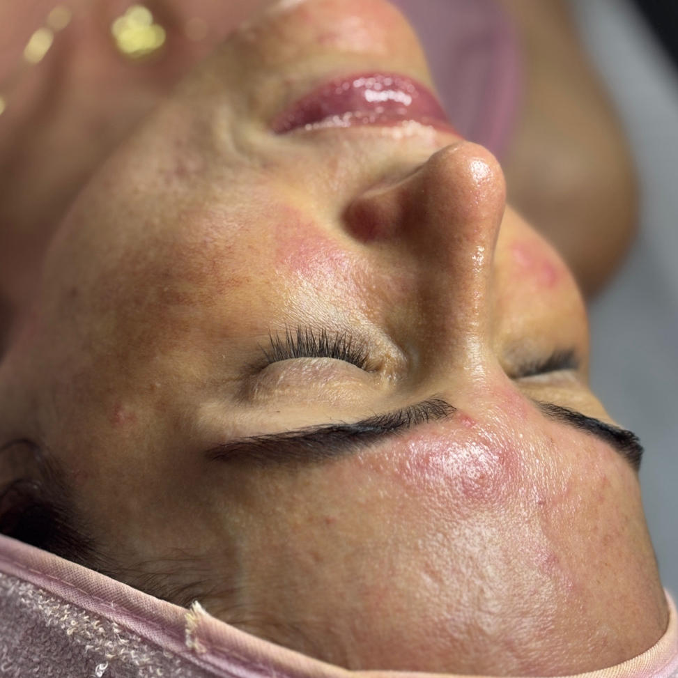 6 - Hidratação Facial e Labial / Peeling de Diamante / Máscara de Colágeno