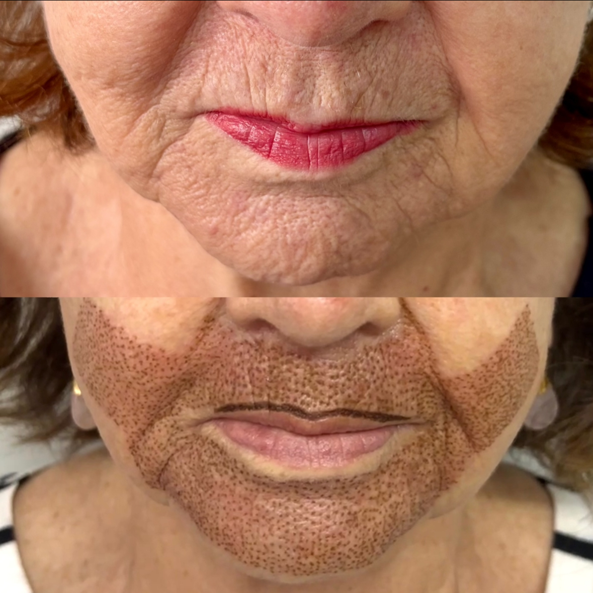 3 - Jato de Plasma ( Região ) Bochechas / Lábio Superior / Queixo / Obs: a sessão do jato de plasma só é feita após a preparação da pele no valor de 150