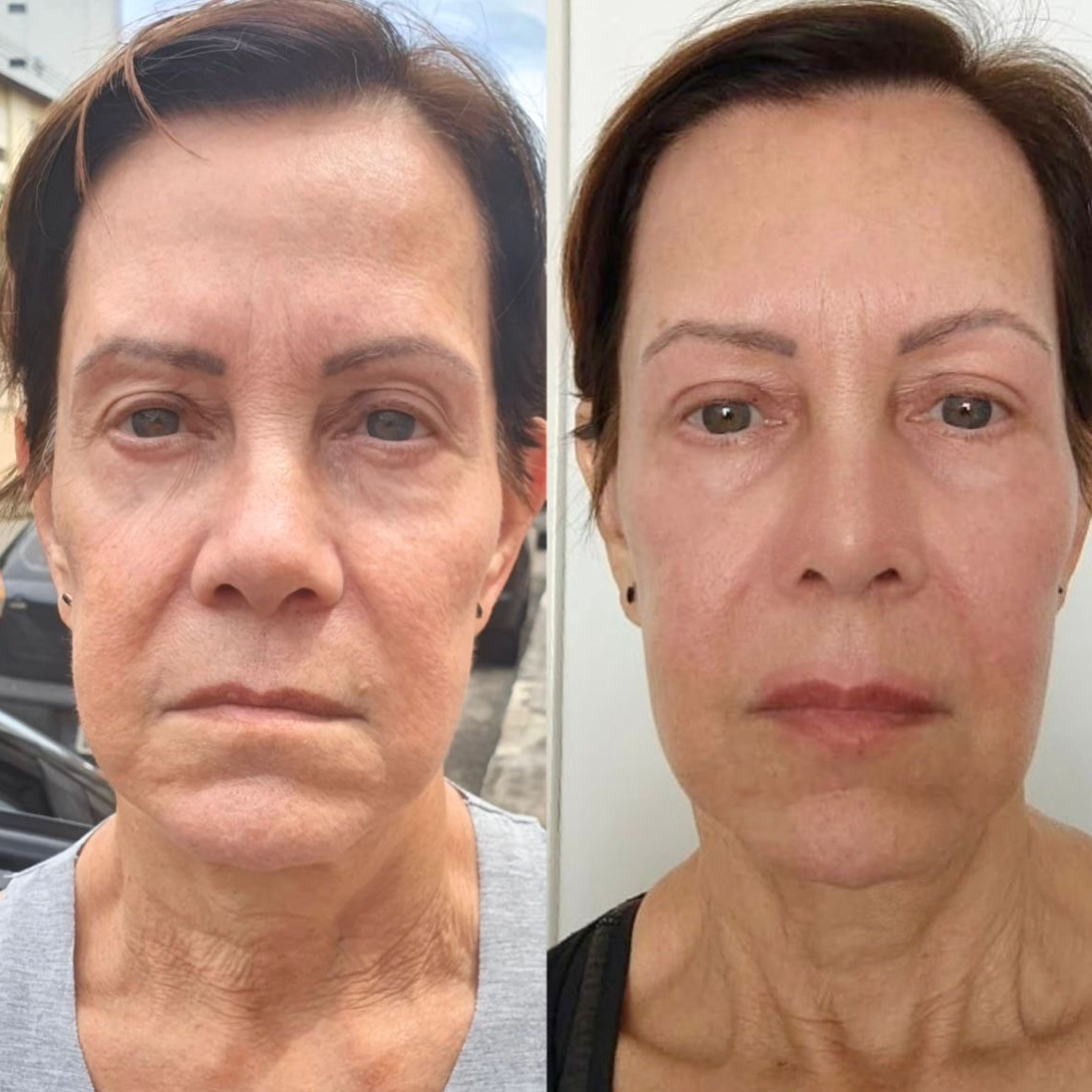 4 - Jato de Plasma Full Face / Você pode escolher 4 regiões / Obs: a sessão do jato de plasma só é feita após a preparação da pele no valor de 150