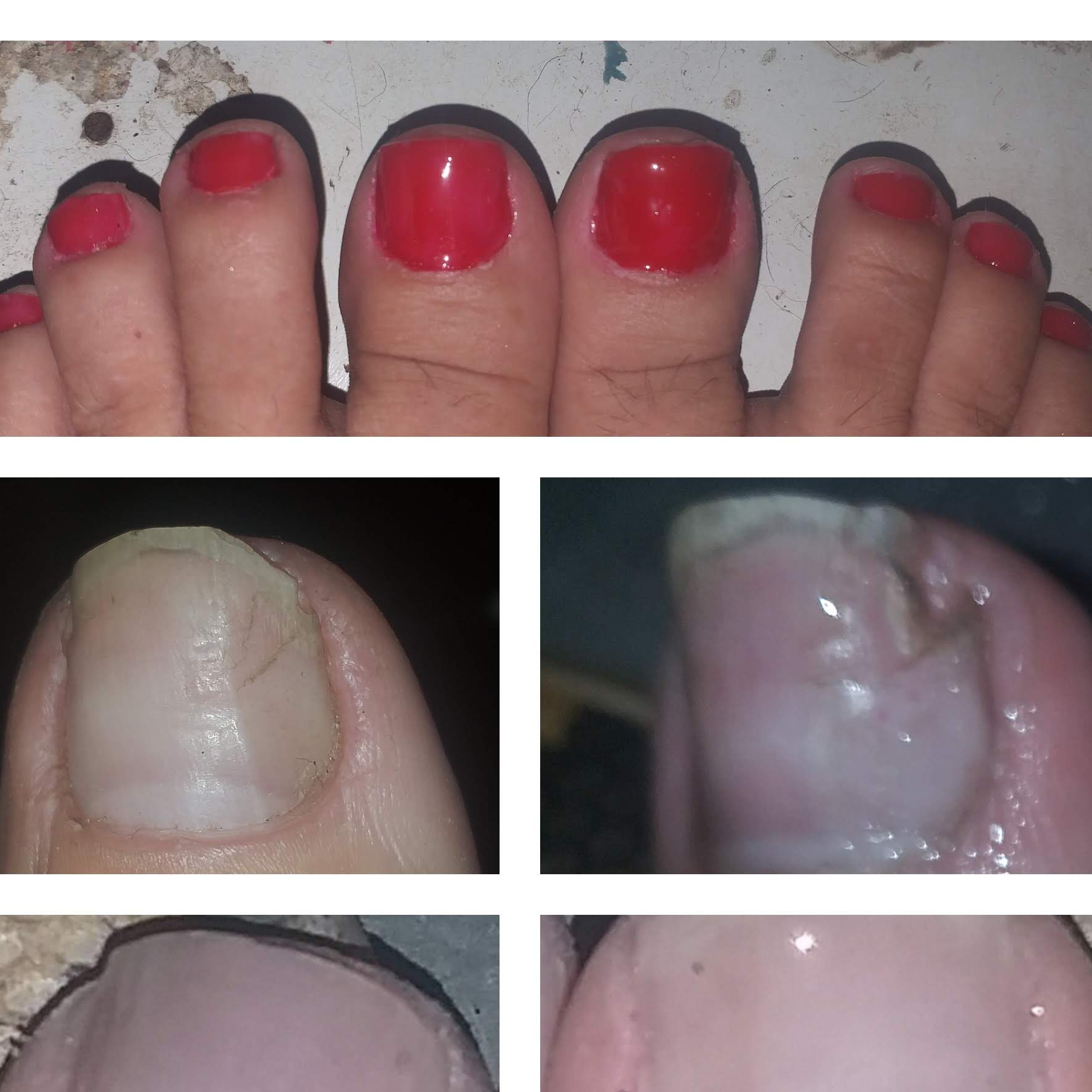 Reconstrução de Unha