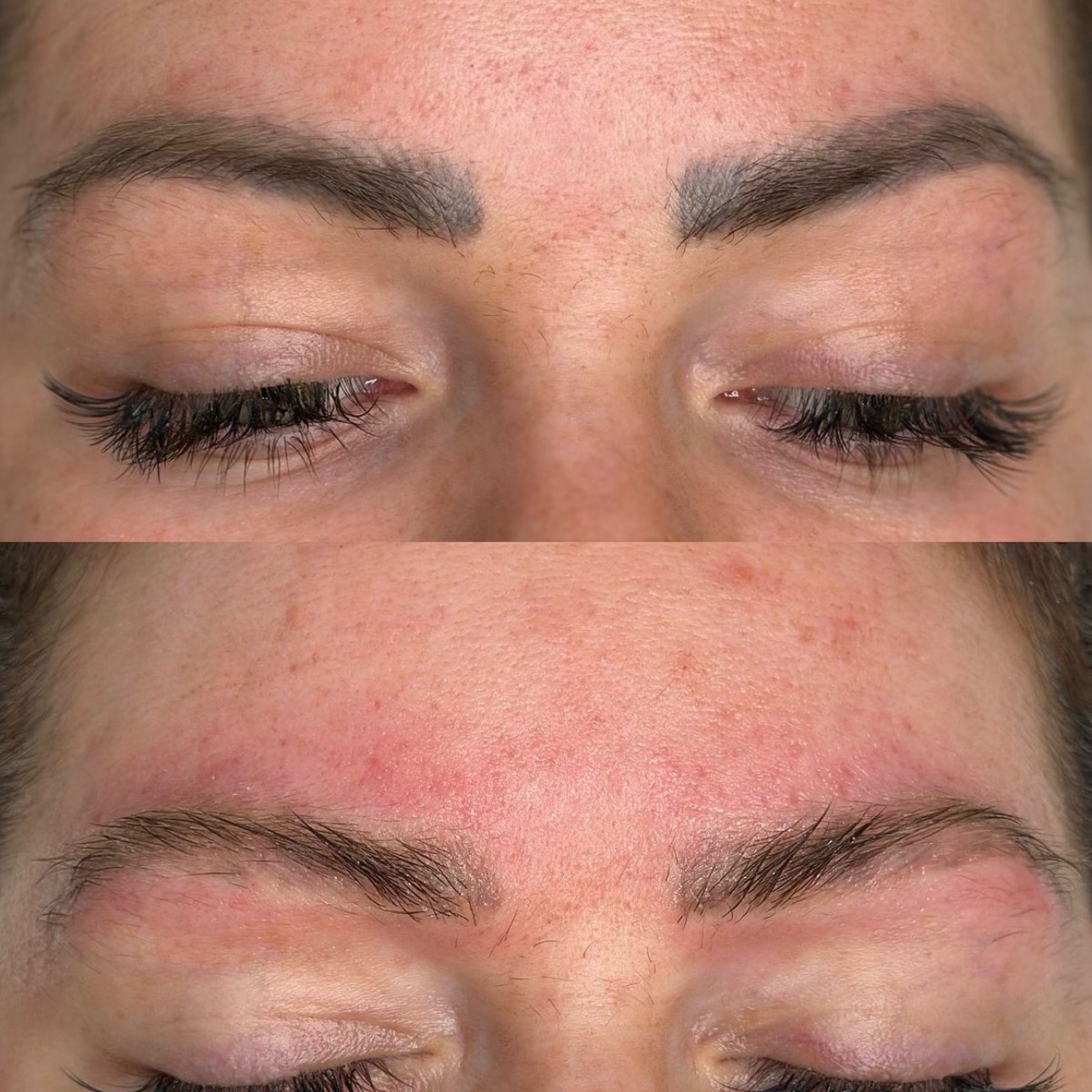 remoção de laser micro sobrancelha