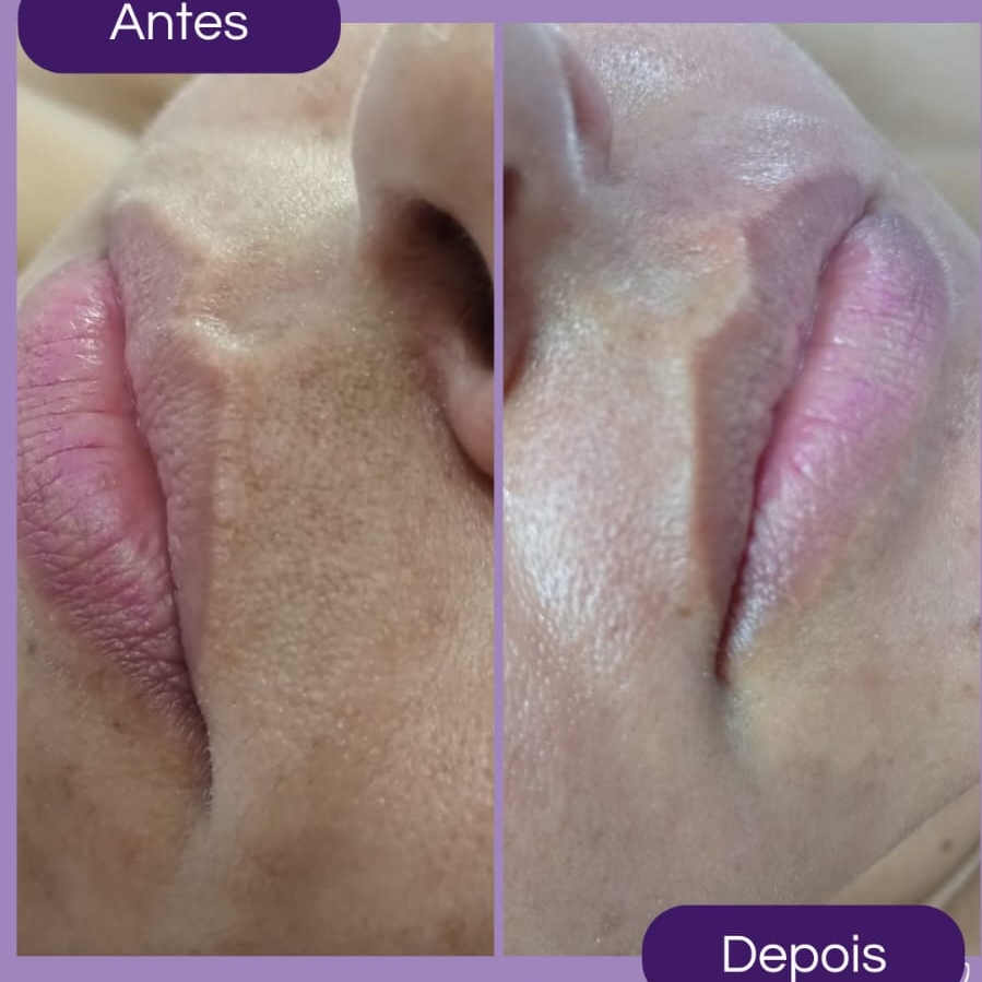 depilação de buço