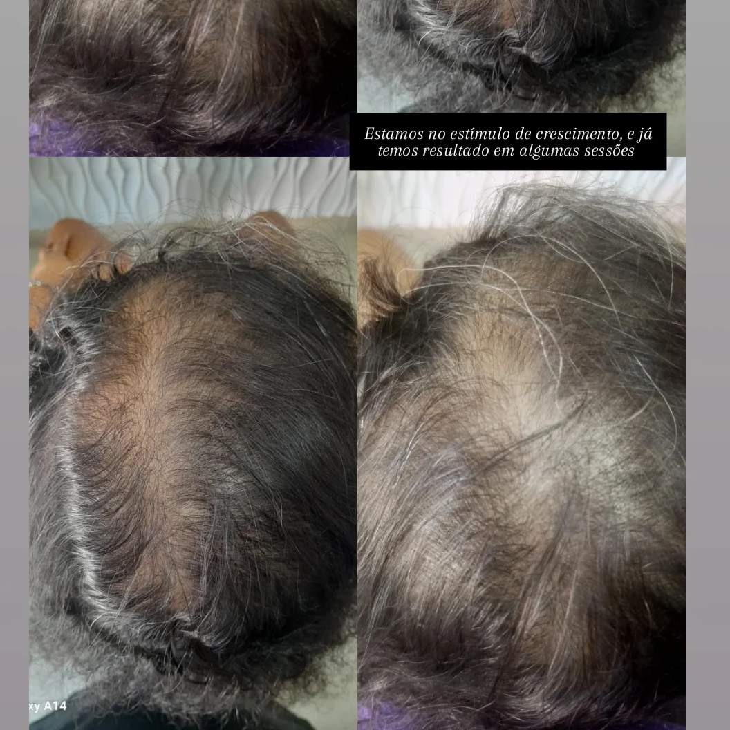 Terapia capilar a partir